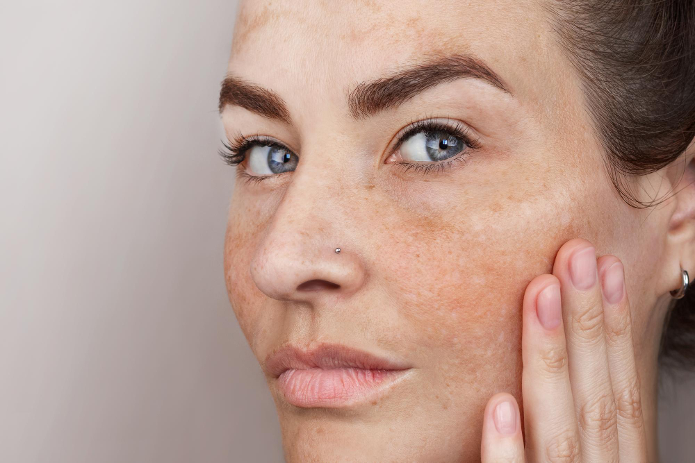 Which Facial is Good for Pigmentation?