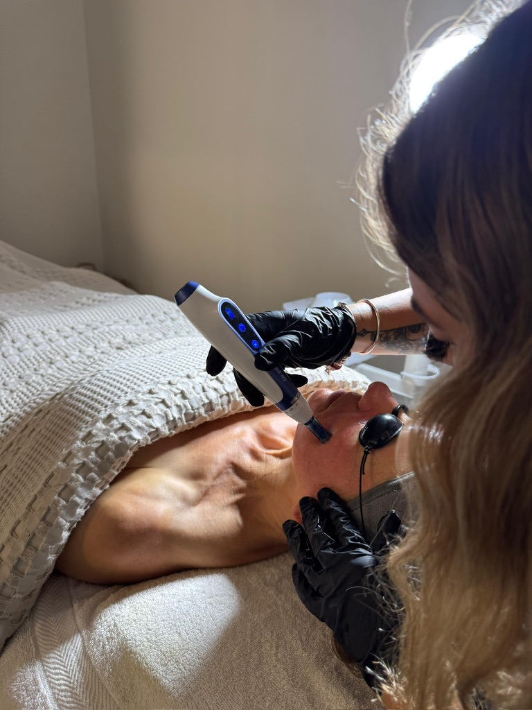 Microneedling Skin Treatment in Murray, UT