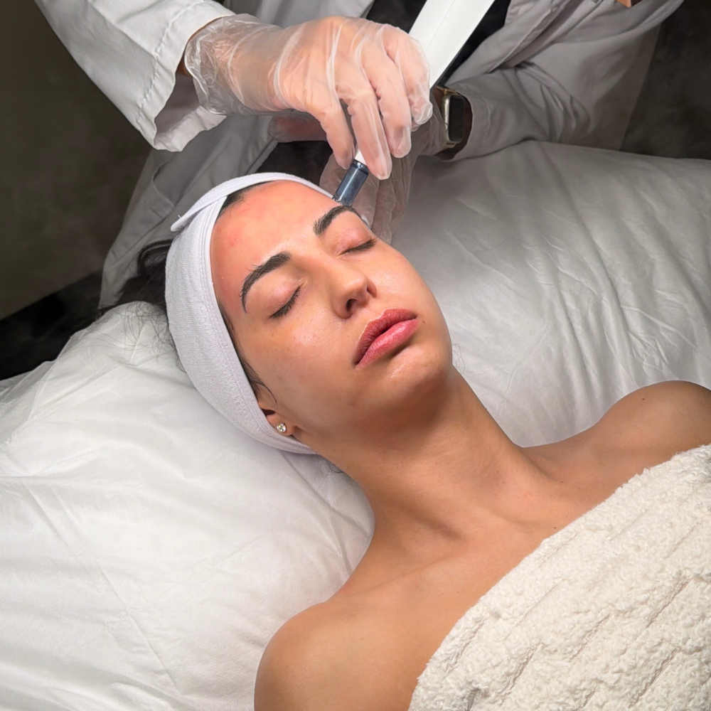 Microneedling With Salmon Dna in murray utah