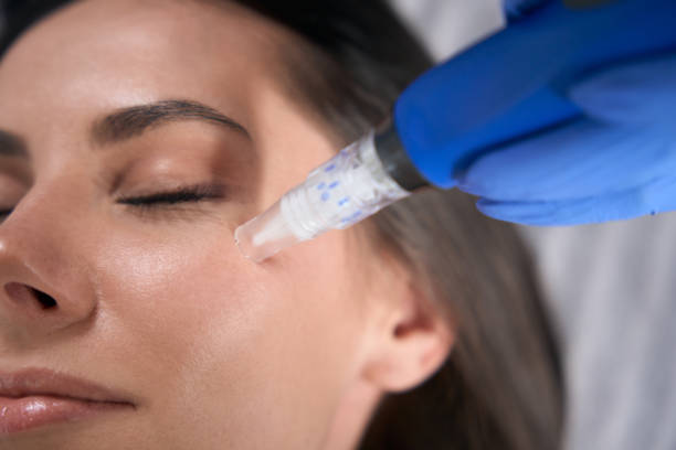 Microneedling Murray UT: Expert Collagen Guide