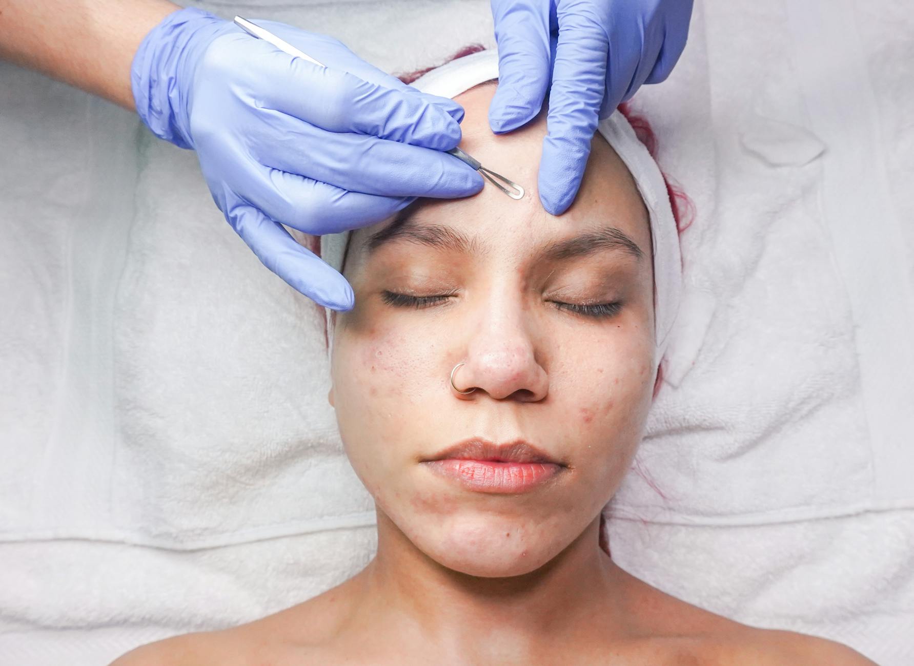 Blackhead and Whitehead Extraction: What to Expect from a Professional Treatment