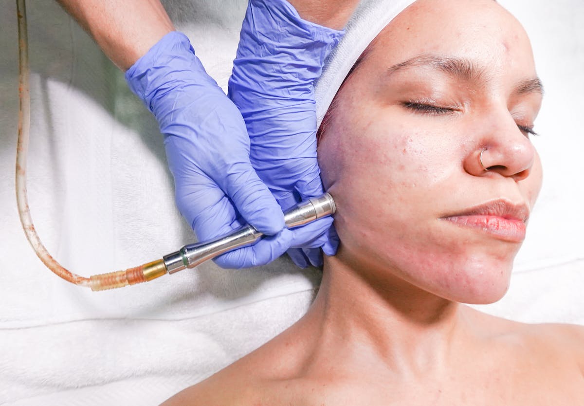 Hyperpigmentation Treatment Salt Lake City: 6 Methods