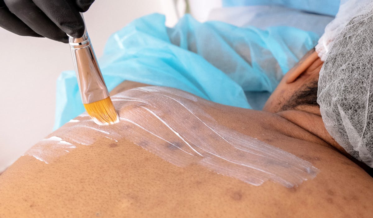 Professional treatment for hyperpigmentation and dark spots