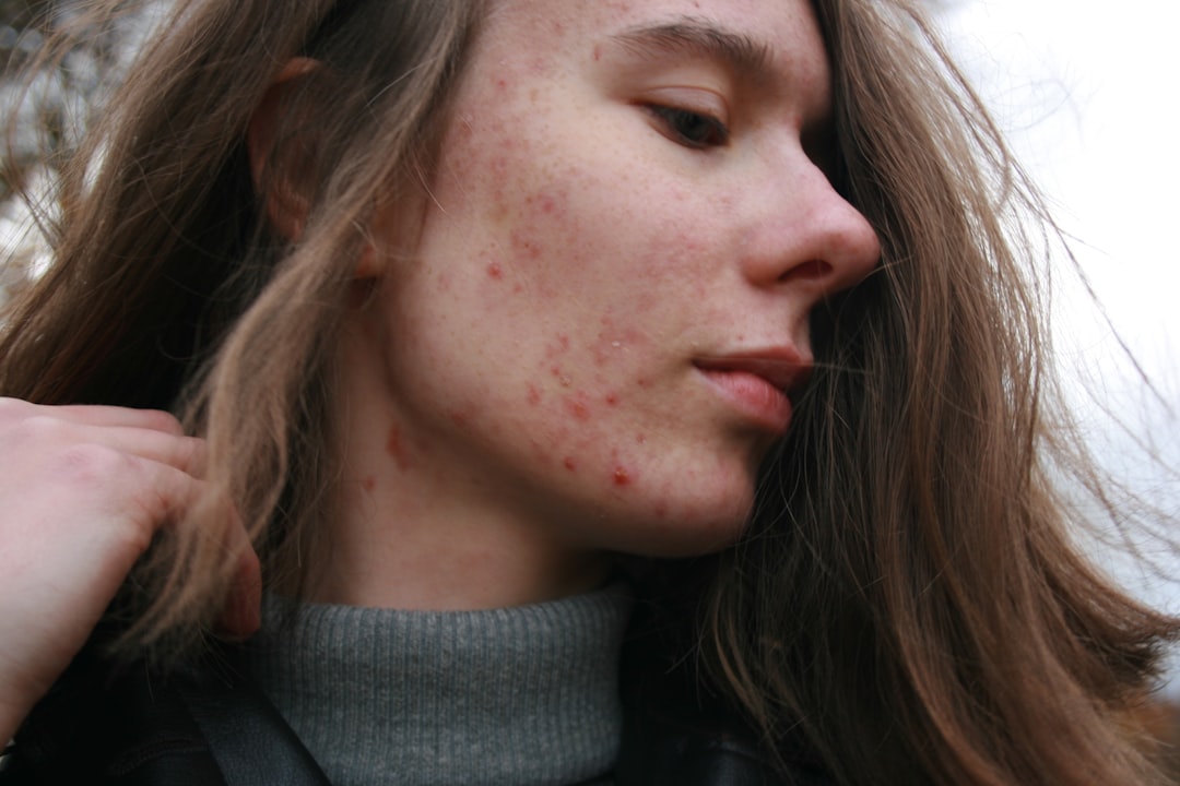 Acne Facial Salt Lake City: 8 Steps to Clear Skin in 2026